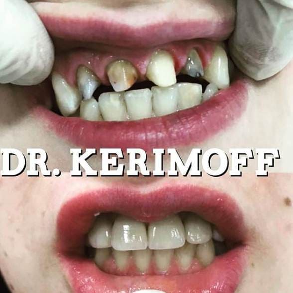 Лечение зубов, доктор Керимов Эшгин