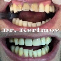 Восстановление зубов, доктор Керимов Эшгин