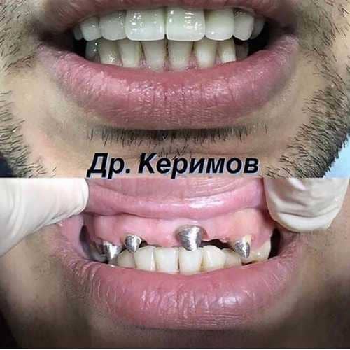 Восстановление зубов, доктор Керимов Эшгин