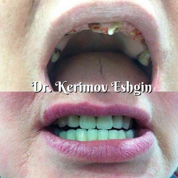 Полное восстановление утраченных зубов, доктор Керимов Эшгин