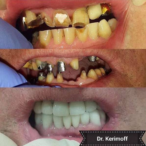 Восстановление верхнего и нижнего зубного ряда, доктор Керимов