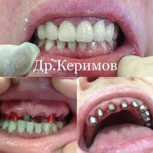 Имплантация зуба, доктор Набиев И.Б.
