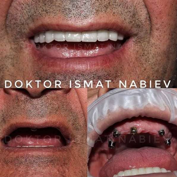 Эстетическая реабилитация зубов, доктор Набиев Исмат