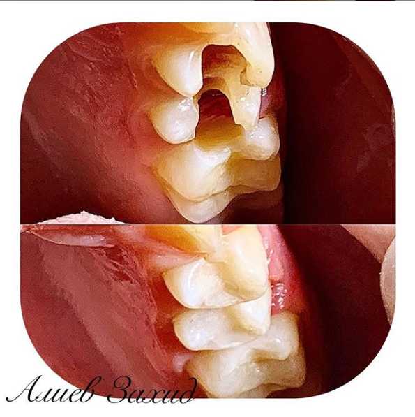 Восстановление зуба с помощью композитной пломбы