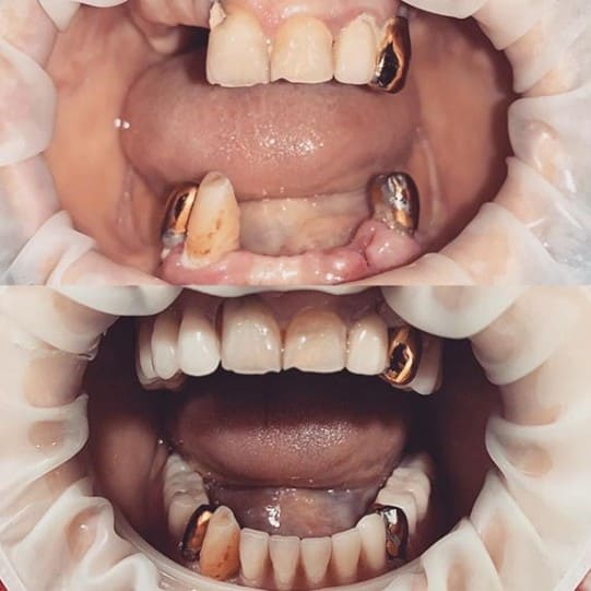Замещение дефекта зубного ряда.
