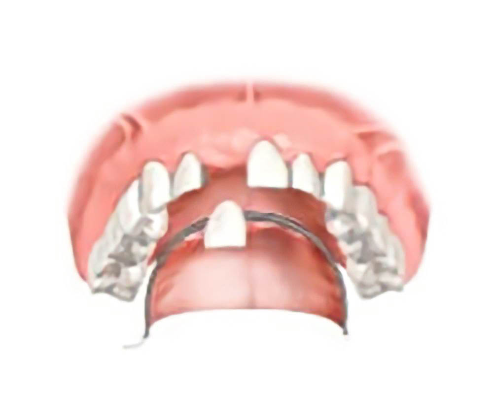 Частично съемный протез при отсутствии одного зуба