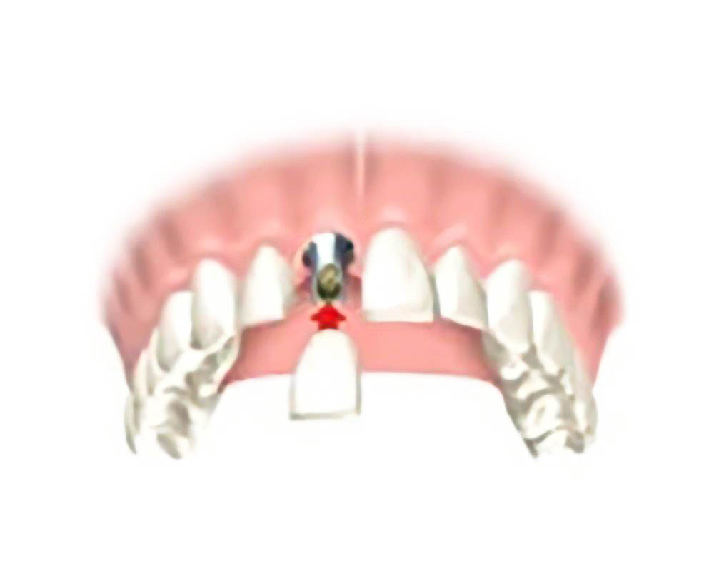 Имплант при отсутствии одного зуба