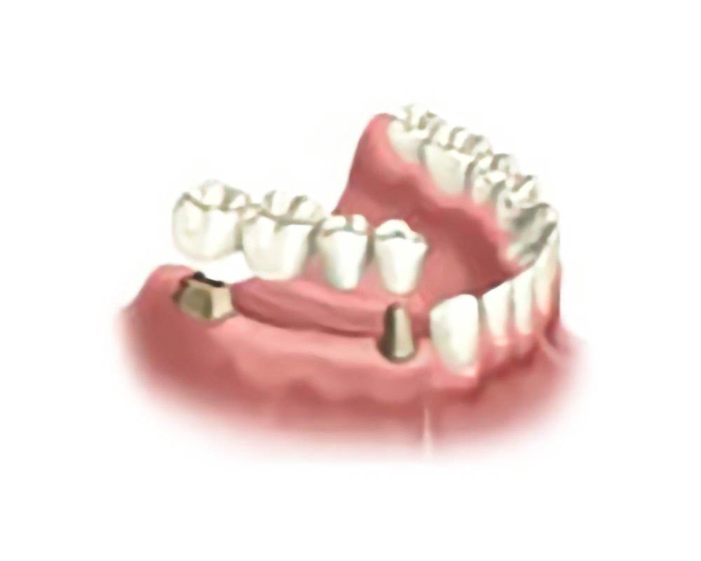 Мостовидный протез при отсутствии нескольких зубов